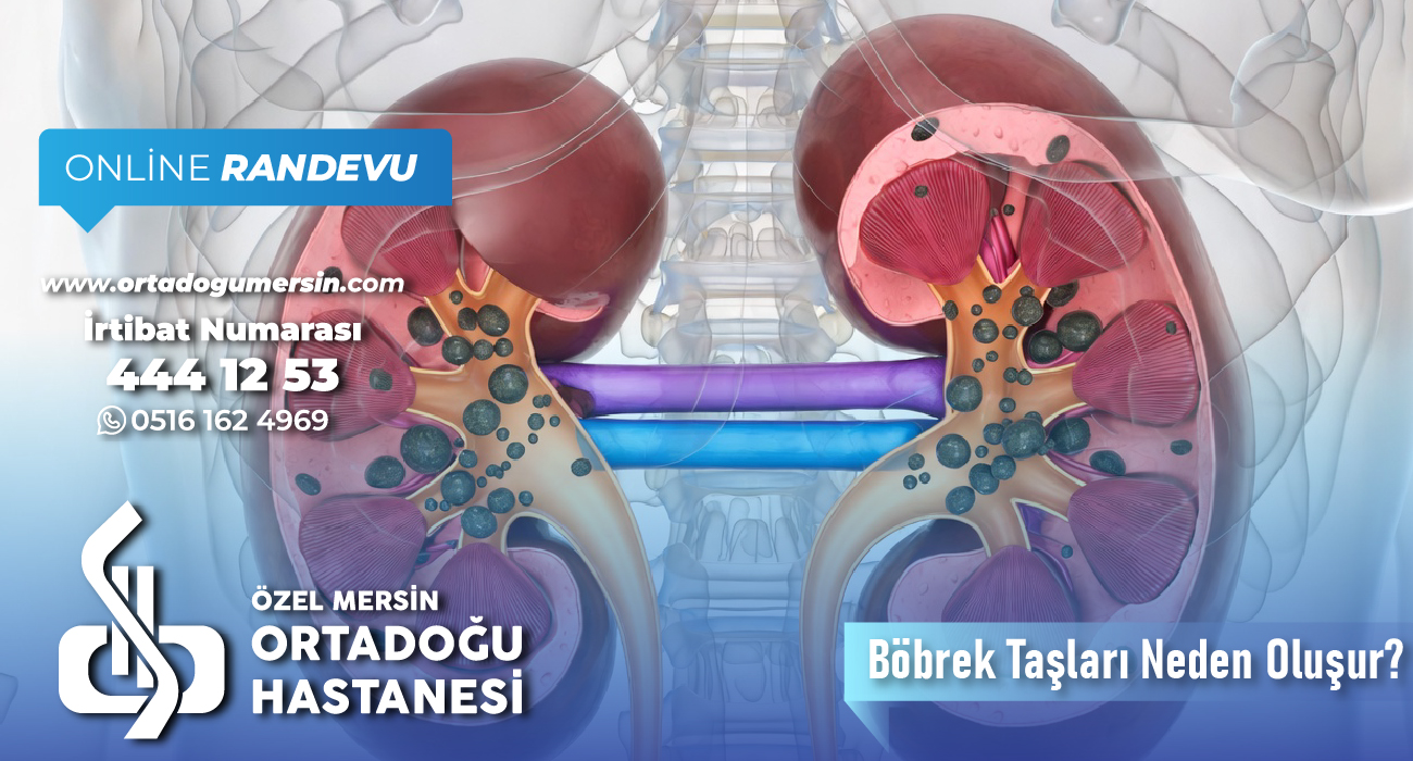 Böbrek Taşları Neden Oluşur?