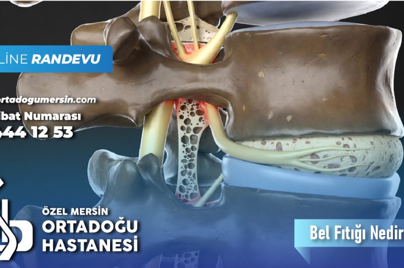 Bel Fıtığı Nedir? Bel Fıtığı Belirtileri ve Tedavi Yöntemleri