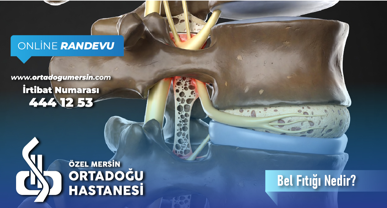 Bel Fıtığı Nedir? Bel Fıtığı Belirtileri ve Tedavi Yöntemleri