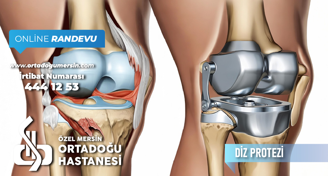 Diz Protezi Nedir? Kimlere Uygulanır? | Özel Mersin Ortadoğu Hastanesi