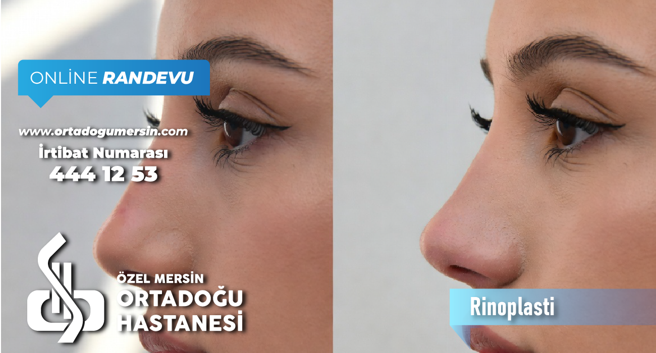 Rinoplasti (Burun Estetiği) Nedir?